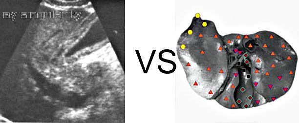 Patient S:NLS VS Ultrasound Study