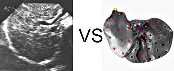 Patient G:NLS VS Ultrasound Study
