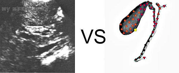 Patient J:NLS VS Ultrasound Study