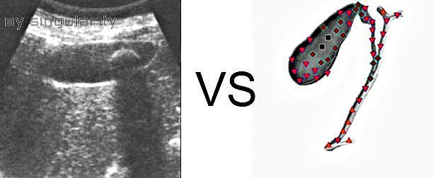 Patient P:NLS VS Ultrasound Study