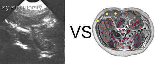 Patient S:NLS VS Ultrasound Study