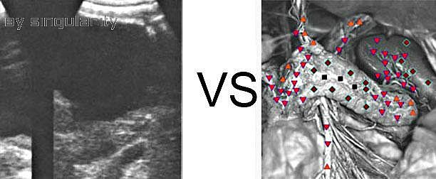Patient A:NLS VS Ultrasound Study