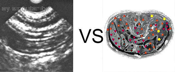 Patient G:NLS VS Ultrasound Study