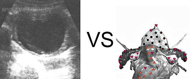 Patient K:NLS VS Ultrasound Study