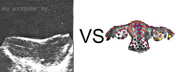 Patient T:NLS VS Ultrasound Study