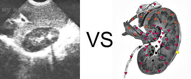 Patient S:NLS VS Ultrasound Study