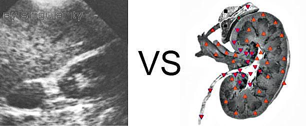 Patient I:NLS VS Ultrasound Study