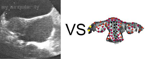 Patient M., 32 years old: Cross section: endometrium