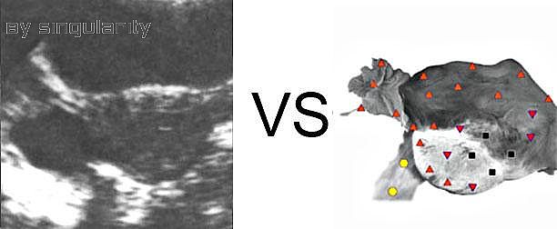 Patient D, 41. Cross section: ovarian cyst with smooth contours