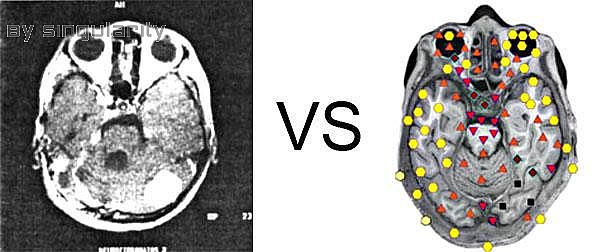 Patient D., aged 57. Neurofibromatosis(NLS Scanner VS. MRI)