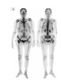 3D-NLS Diagnostics of metastatic skeletal lesions