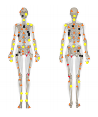 3D-NLS Diagnostics of metastatic skeletal lesions