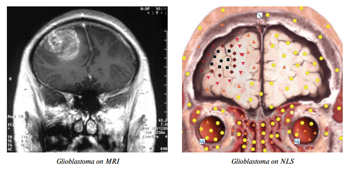 Combined radiation therapy and 3D-NLS meta-therapy of glioblastoma in elderly patients