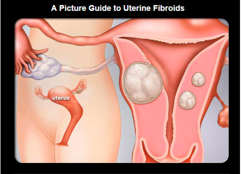 What causes uterine fibroids and how common are they?