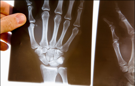 What Is rheumatoid arthritis?