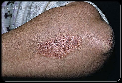 What Is Psoriasis?