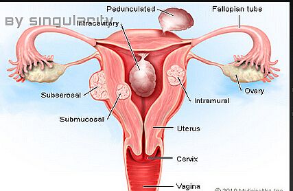 3D-NLS can analyze uterine fibroids?
