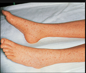 Picture of Rocky Mountain Spotted Fever (Legs)