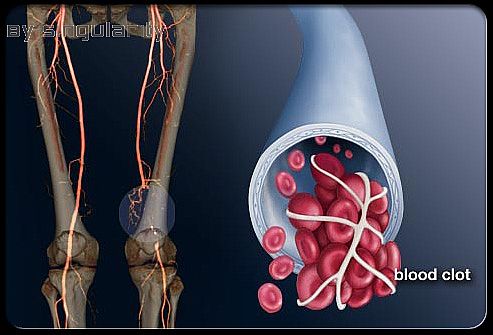 What Is DVT?