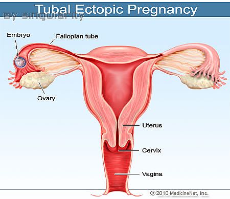What is an ectopic pregnancy?